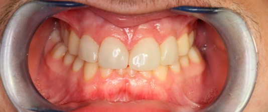 agenesias de molares