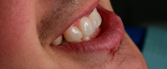 agenesias de molares